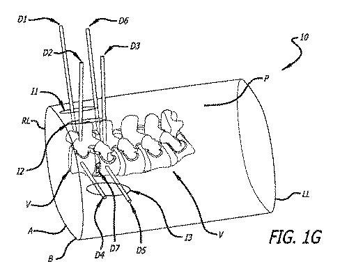 6475762-複数の脊椎外科的経路システムおよび方法 図000010