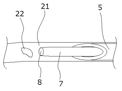 6647891-網膜血管血栓除去用器具 図000010