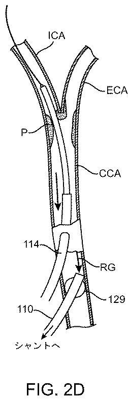 6768697-頚動脈血流の逆流を確立する方法およびシステム 図000010