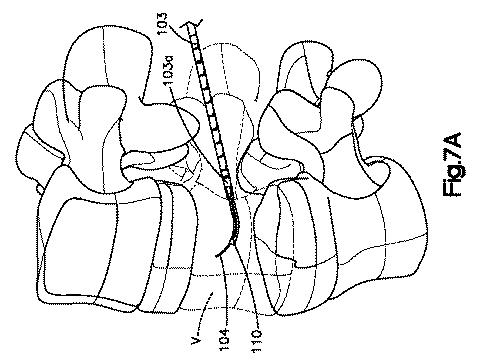 5662999-最小限の侵襲性の脊柱補強及び安定化のシステム及び方法 図000011