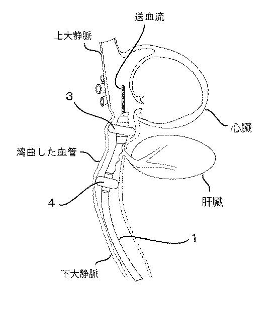 6220102-斜め膨脹型バルーンカテーテル及びバルーン用土台 図000011