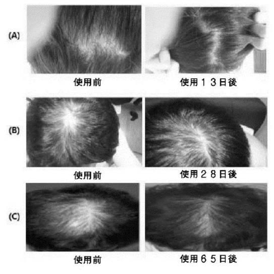 6734250-ソホロリピッドを有効成分として含有する脱毛防止または発毛促進用組成物の製造方法 図000011