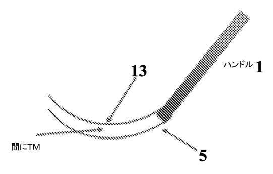 6815416-眼科ナイフ及び使用方法 図000011