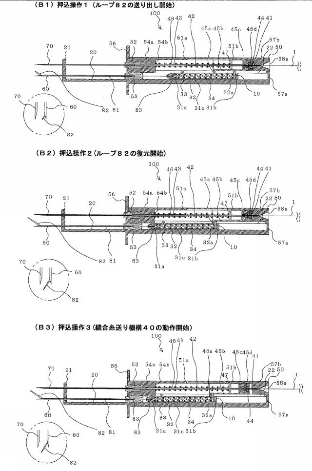 5946335-医療用縫合具 図000012