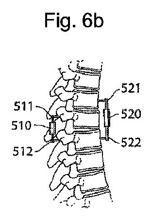 6636420-骨整形用の装置および方法 図000012