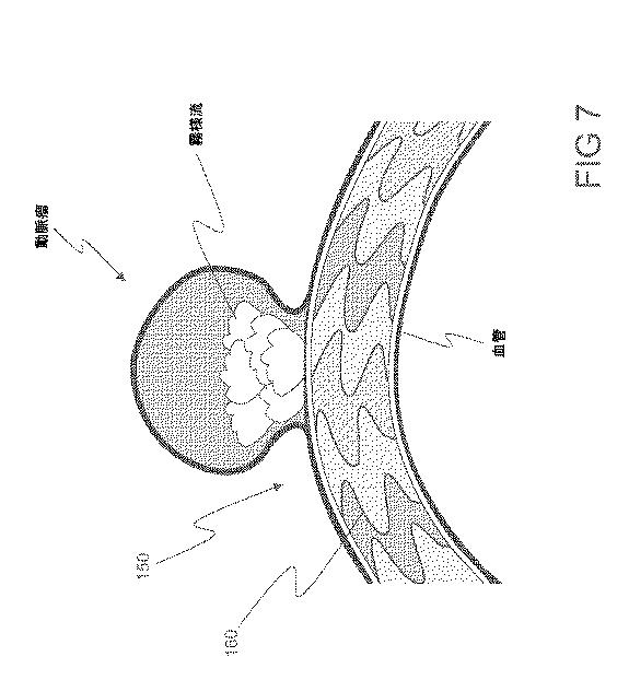 6793147-動脈瘤を治療するためのデバイスおよび方法 図000012