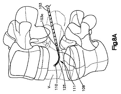 5662999-最小限の侵襲性の脊柱補強及び安定化のシステム及び方法 図000013