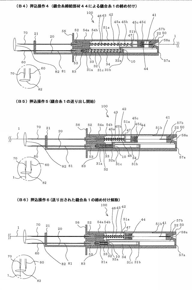 5946335-医療用縫合具 図000013