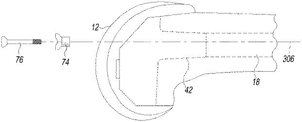 6419442-二次的保持を備えるプロテーゼ構成要素 図000013