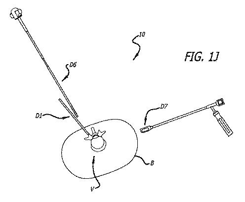 6475762-複数の脊椎外科的経路システムおよび方法 図000013