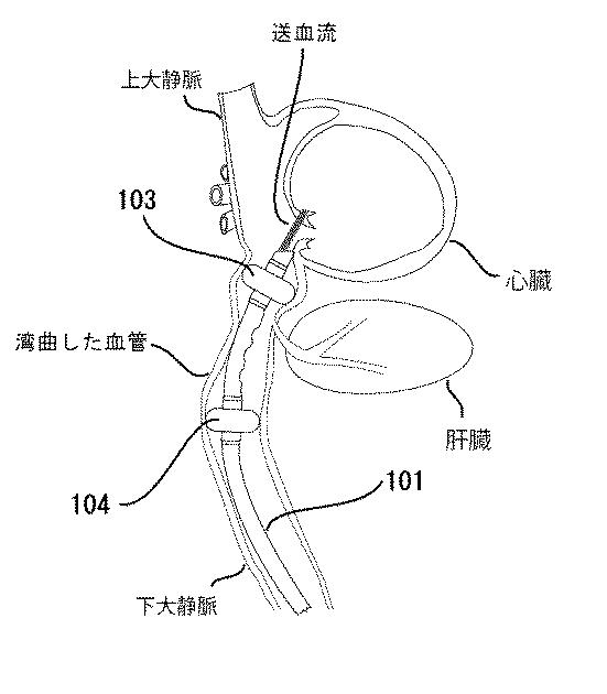 6220102-斜め膨脹型バルーンカテーテル及びバルーン用土台 図000014