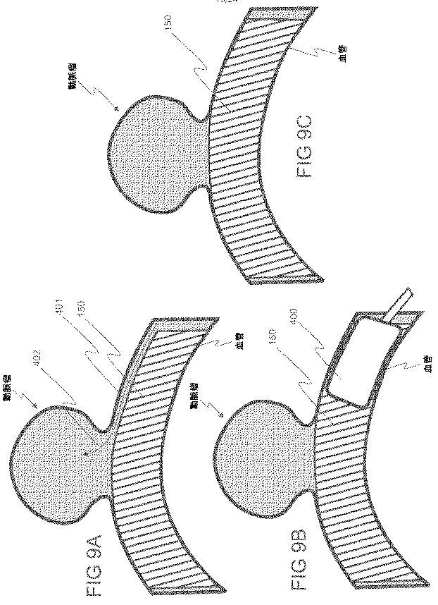 6793147-動脈瘤を治療するためのデバイスおよび方法 図000014