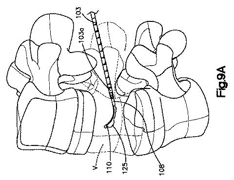 5662999-最小限の侵襲性の脊柱補強及び安定化のシステム及び方法 図000015