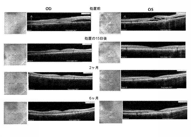 6425785-網膜中および／または網膜下における液体貯留の処置のための方法および組成物 図000015