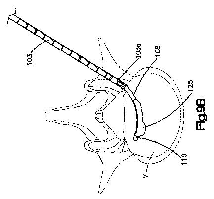 5662999-最小限の侵襲性の脊柱補強及び安定化のシステム及び方法 図000016