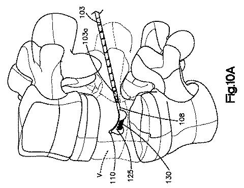 5662999-最小限の侵襲性の脊柱補強及び安定化のシステム及び方法 図000017