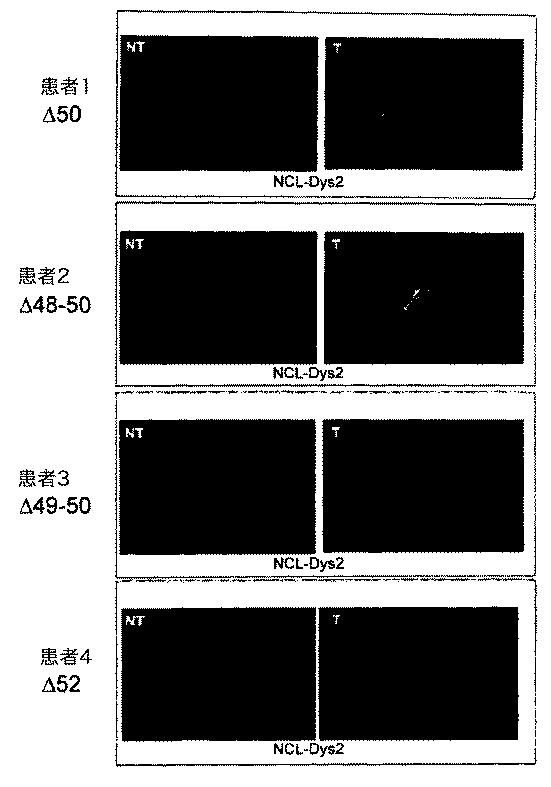 5879374-筋障害を相殺するための手段と方法 図000017