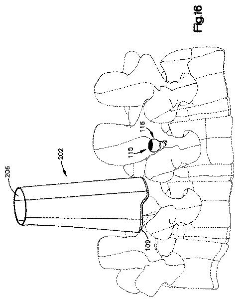 5658237-患者装着式開創器 図000018