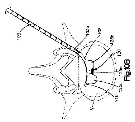 5662999-最小限の侵襲性の脊柱補強及び安定化のシステム及び方法 図000018