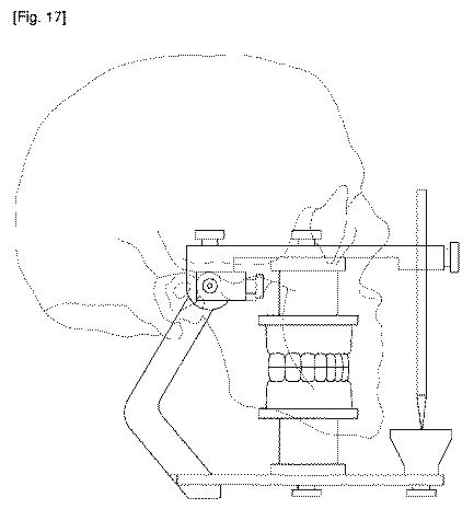 5688620-咬合器 図000018