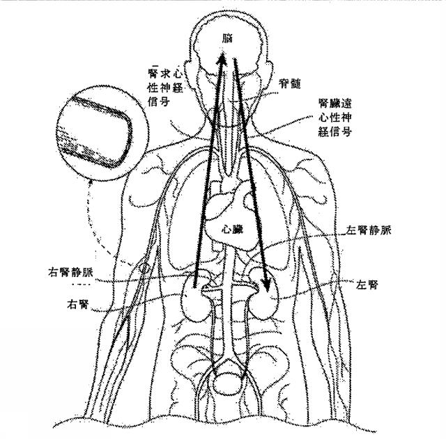 6267774-神経変調療法の評価及びフィードバックのためのデバイス、システム、及び方法 図000018