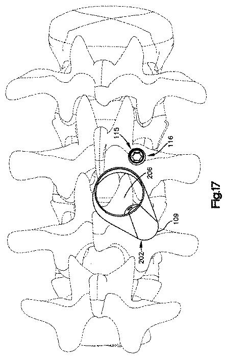 5658237-患者装着式開創器 図000019