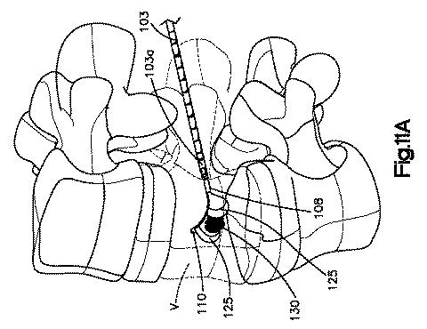 5662999-最小限の侵襲性の脊柱補強及び安定化のシステム及び方法 図000019