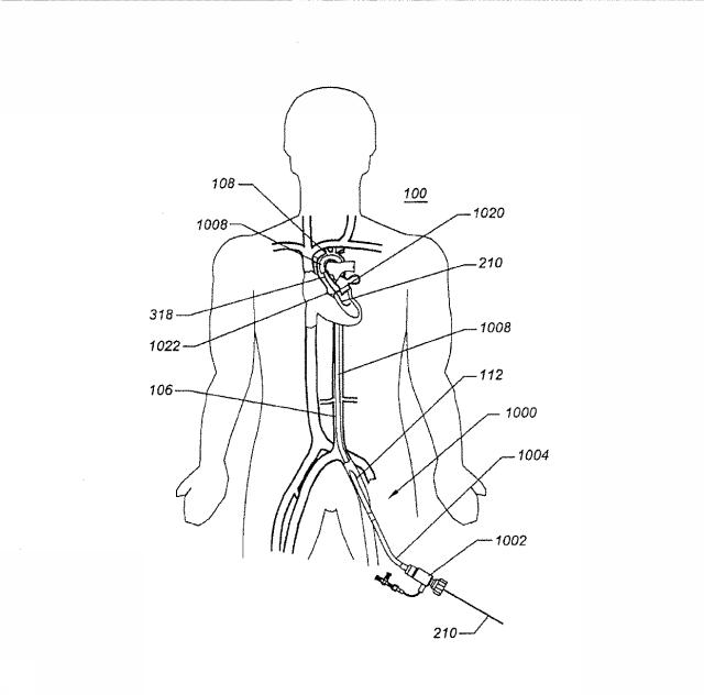 6069392-拡張可能な腸骨シースと使用方法 図000019