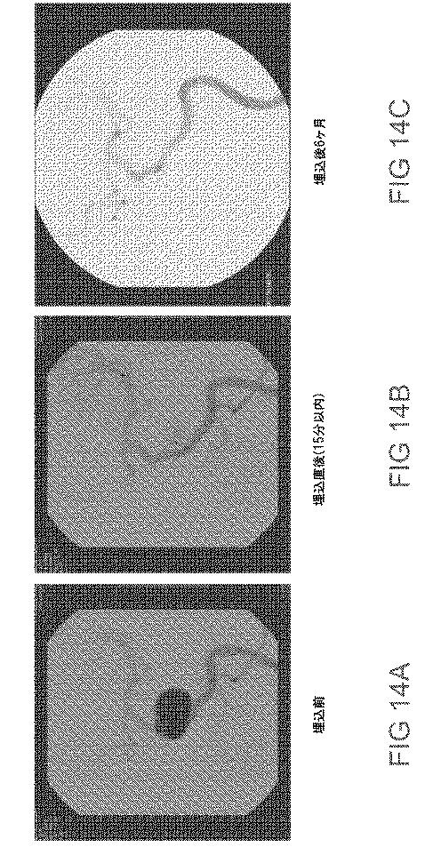 6793147-動脈瘤を治療するためのデバイスおよび方法 図000019