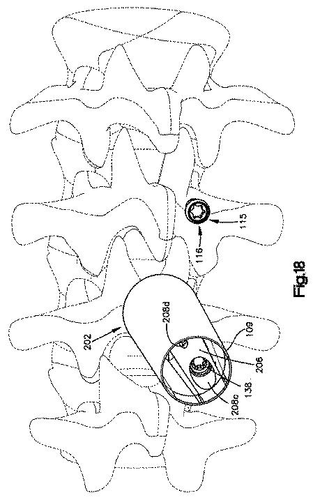 5658237-患者装着式開創器 図000020