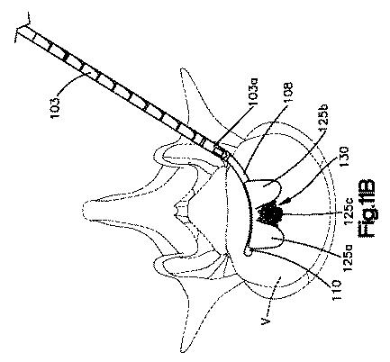 5662999-最小限の侵襲性の脊柱補強及び安定化のシステム及び方法 図000020