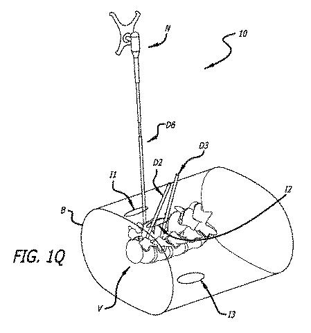 6475762-複数の脊椎外科的経路システムおよび方法 図000020