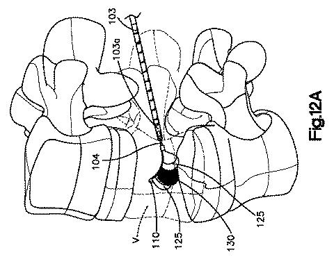 5662999-最小限の侵襲性の脊柱補強及び安定化のシステム及び方法 図000021