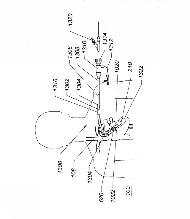 6069392-拡張可能な腸骨シースと使用方法 図000021