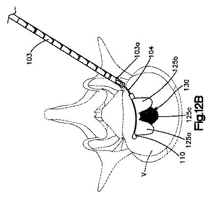 5662999-最小限の侵襲性の脊柱補強及び安定化のシステム及び方法 図000022