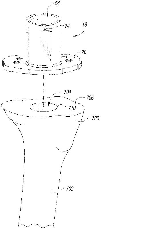 6433665-オフセットを設定するための脛骨の整形外科用手術器具 図000022