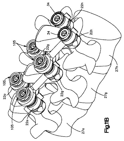 5654584-脊柱構築用の修正コネクタ 図000023