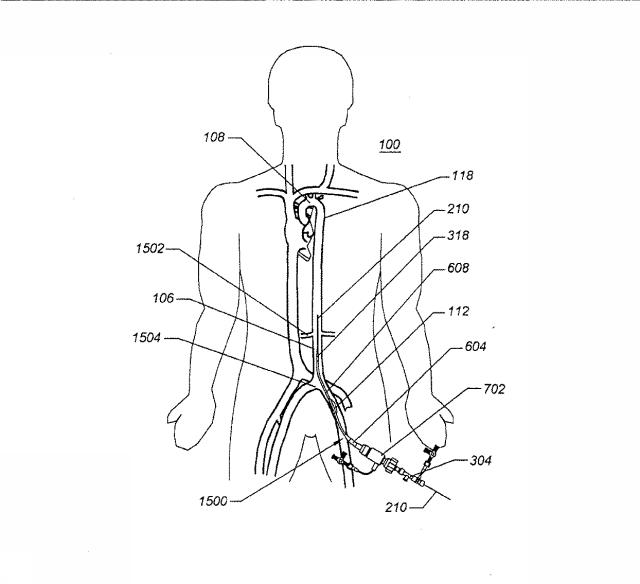 6069392-拡張可能な腸骨シースと使用方法 図000024