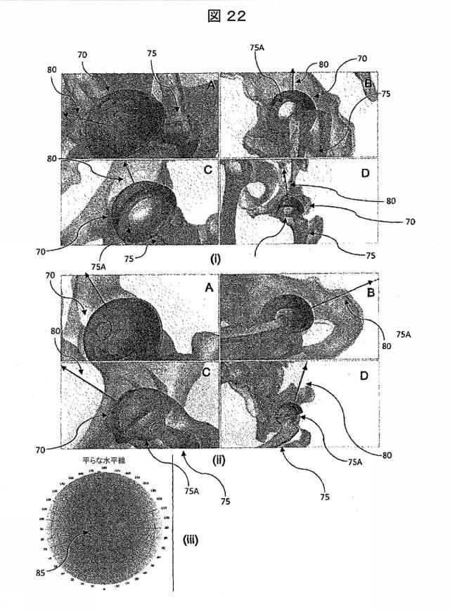 6979445-患者の関節用の整形外科インプラントの位置合わせをモデル化するためのコンピュータ装置の作動方法およびコンピュータ装置 図000025
