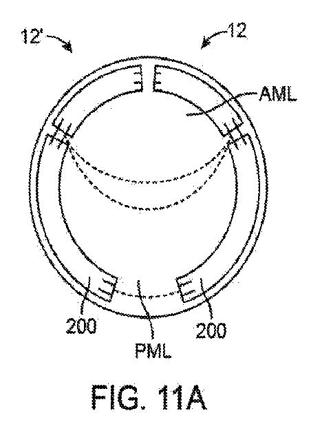 6010545-僧帽弁の修復および置換のためのシステム 図000026