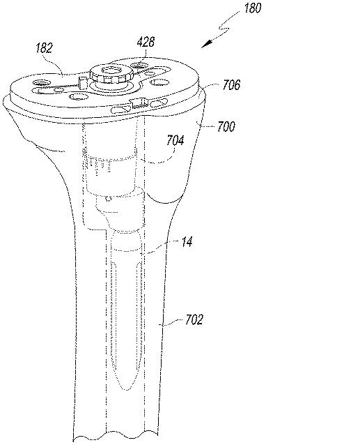 6433665-オフセットを設定するための脛骨の整形外科用手術器具 図000028