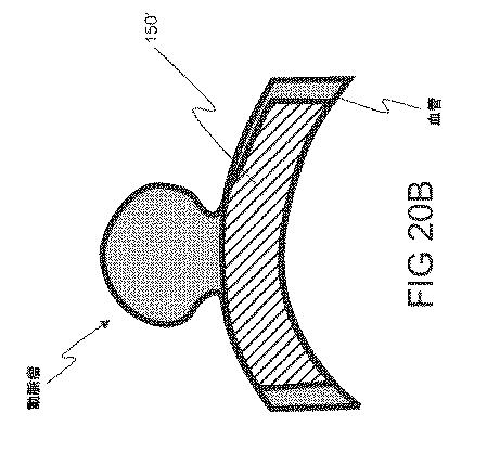 6793147-動脈瘤を治療するためのデバイスおよび方法 図000030
