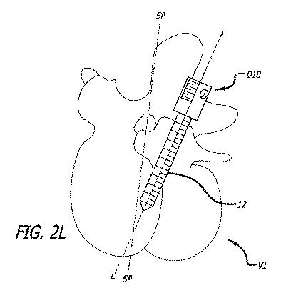 6475762-複数の脊椎外科的経路システムおよび方法 図000032
