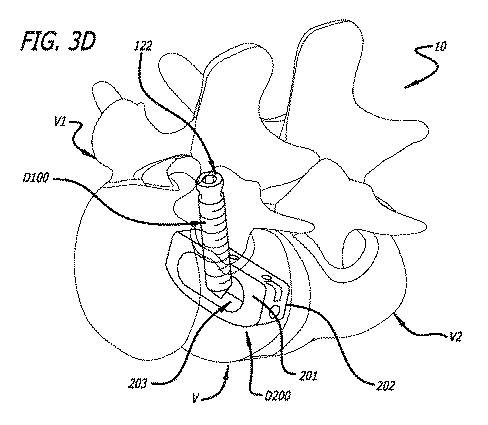 6475762-複数の脊椎外科的経路システムおよび方法 図000037