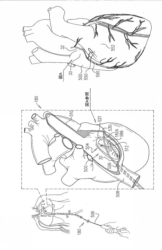 6816889-引張り部材を有する偏心組織アンカー 図000038