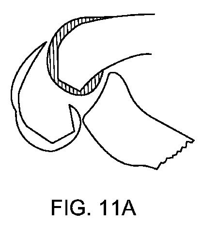 5837876-人工膝患者に深膝屈曲能力を提供するシステム及び方法 図000039