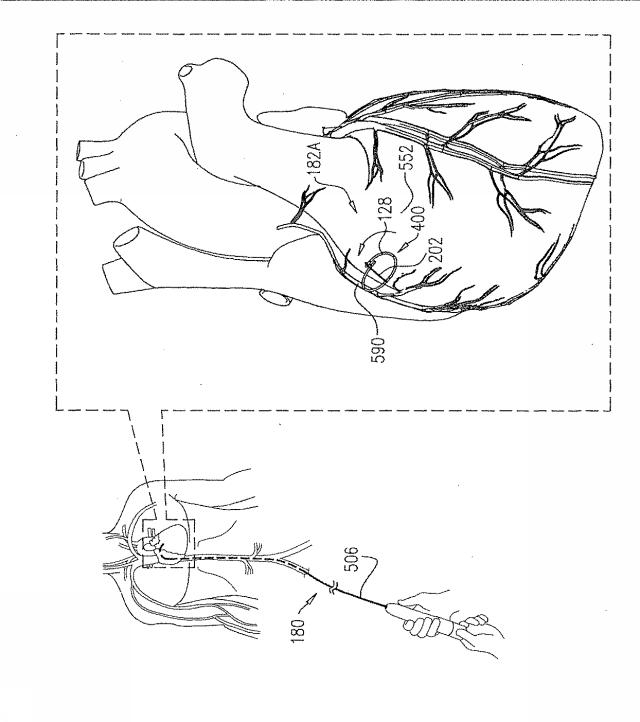 6816889-引張り部材を有する偏心組織アンカー 図000039