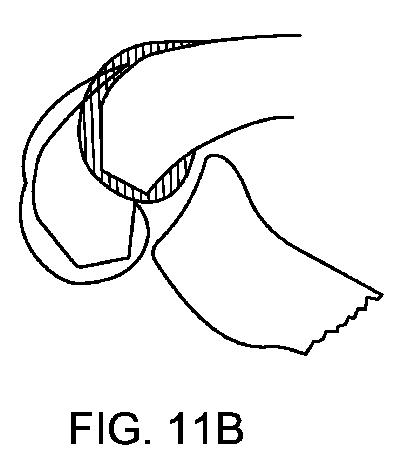 5837876-人工膝患者に深膝屈曲能力を提供するシステム及び方法 図000040