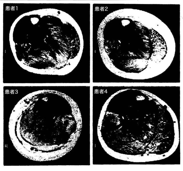 5879374-筋障害を相殺するための手段と方法 図000040