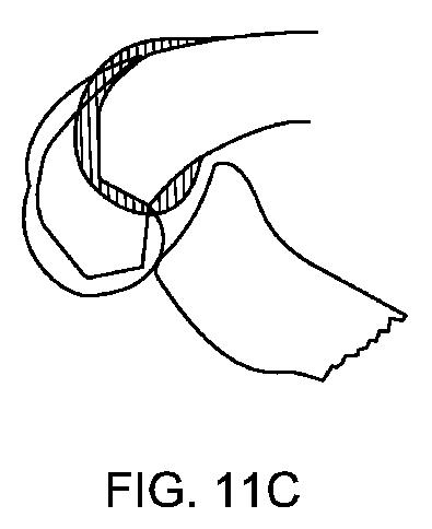 5837876-人工膝患者に深膝屈曲能力を提供するシステム及び方法 図000041